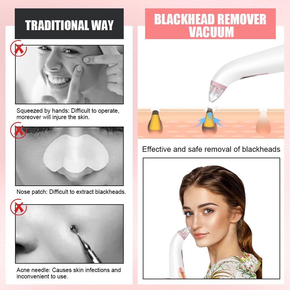 AOGOE Blackhead Remover Pore Vacuum 5 Modes 3 Suction Tips USB Rechargeable White