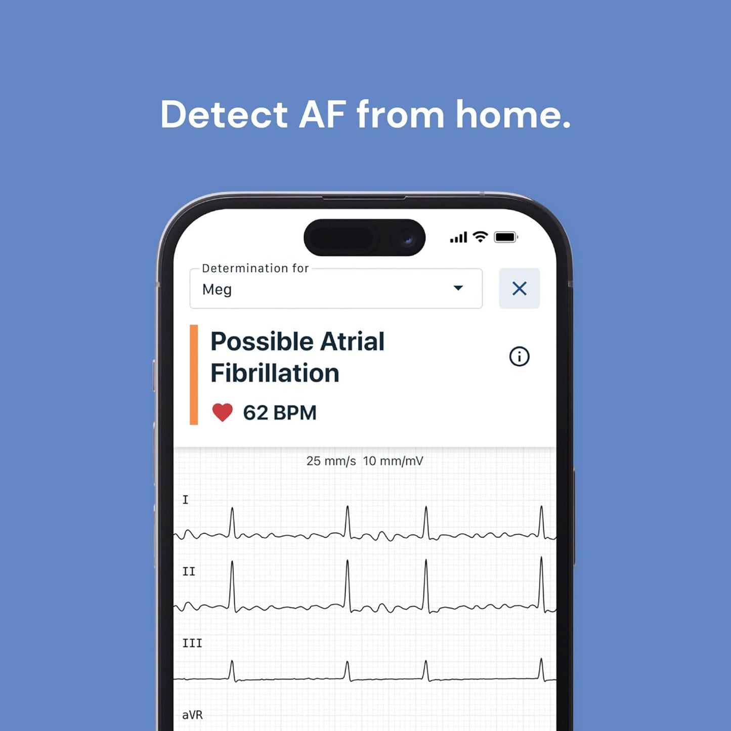 KardiaMobile 6-Lead Personal ECG Heart Rate Monitor – Pocket‑Size Medical‑Grade Tracker