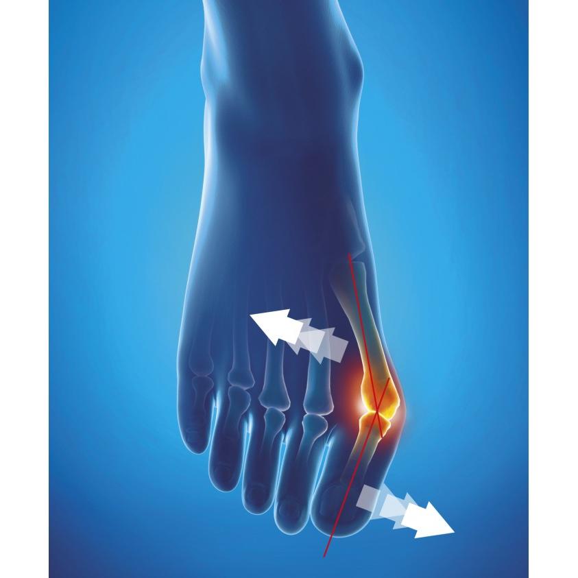 Epitact Flexible Hallux Valgus Correction Bandage for Daily Wear, Small Size