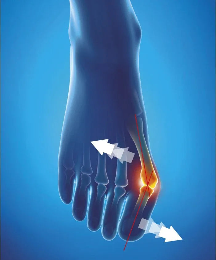 Epitact Night Bunion Corrector: Thermoformable Splint for Hallux Valgus Relief - Gomix Brands Outlet